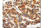 The image on the left is immunohistochemistry of paraffin-embedded Human lung cancer tissue using CSB-PA967715(ABCB5 Antibody) at dilution 1/10, on the right is treated with fusion protein. (Original magnification: 