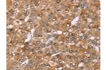 The image on the left is immunohistochemistry of paraffin-embedded Human liver cancer tissue using CSB-PA967887(AKR1C4 Antibody) at dilution 1/30, on the right is treated with fusion protein. (Original magnification: 