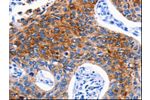 The image on the left is immunohistochemistry of paraffin-embedded Human lung cancer tissue using CSB-PA967891(DRD4 Antibody) at dilution 1/30, on the right is treated with synthetic peptide. (Original magnification: 