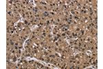 The image on the left is immunohistochemistry of paraffin-embedded Human liver cancer tissue using CSB-PA967899(CSNK2A1 Antibody) at dilution 1/30, on the right is treated with fusion protein. (Original magnification: 