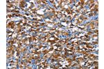 The image on the left is immunohistochemistry of paraffin-embedded Human thyroid cancer tissue using CSB-PA968069(CD226 Antibody) at dilution 1/60, on the right is treated with synthetic peptide. (Original magnification: 
