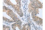 The image on the left is immunohistochemistry of paraffin-embedded Human colon cancer tissue using CSB-PA968134(CHRNA10 Antibody) at dilution 1/50, on the right is treated with synthetic peptide. (Original magnification: 
