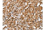 The image on the left is immunohistochemistry of paraffin-embedded Human thyroid cancer tissue using CSB-PA968280(DEFA4 Antibody) at dilution 1/20, on the right is treated with synthetic peptide. (Original magnification: 