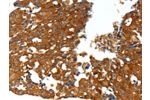 The image on the left is immunohistochemistry of paraffin-embedded Human breast cancer tissue using CSB-PA968386(CXCL12 Antibody) at dilution 1/20, on the right is treated with synthetic peptide. (Original magnification: 