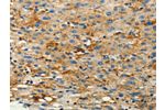 The image on the left is immunohistochemistry of paraffin-embedded Human liver cancer tissue using CSB-PA968401(CFTR Antibody) at dilution 1/10, on the right is treated with synthetic peptide. (Original magnification: 