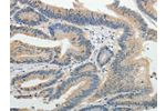 The image on the left is immunohistochemistry of paraffin-embedded Human colon cancer tissue using CSB-PA968757(BIRC5 Antibody) at dilution 1/25, on the right is treated with fusion protein. (Original magnification: 