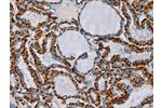 The image on the left is immunohistochemistry of paraffin-embedded Human thyroid cancer tissue using CSB-PA968805(CMC4 Antibody) at dilution 1/55, on the right is treated with fusion protein. (Original magnification: 