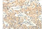 The image on the left is immunohistochemistry of paraffin-embedded Human lung cancer tissue using CSB-PA968818(FOXR2 Antibody) at dilution 1/25, on the right is treated with fusion protein. (Original magnification: 