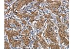 The image on the left is immunohistochemistry of paraffin-embedded Human gastic cancer tissue using CSB-PA969205(CD163  Antibody) at dilution 1/30, on the right is treated with synthetic peptide. (Original magnification: 