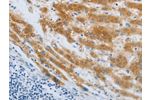 The image on the left is immunohistochemistry of paraffin-embedded Human liver cancer tissue using CSB-PA969473(CHRFAM7A Antibody) at dilution 1/40, on the right is treated with synthetic peptide. (Original magnification: 