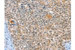 The image on the left is immunohistochemistry of paraffin-embedded Human cervical cancer tissue using CSB-PA969647(ALDOB Antibody) at dilution 1/40, on the right is treated with synthetic peptide. (Original magnification: 