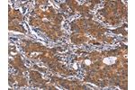 The image on the left is immunohistochemistry of paraffin-embedded Human gastic cancer tissue using CSB-PA969762(GLS Antibody) at dilution 1/25, on the right is treated with synthetic peptide. (Original magnification: 