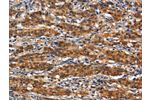 The image on the left is immunohistochemistry of paraffin-embedded Human gastic cancer tissue using CSB-PA969898(ANPEP Antibody) at dilution 1/80, on the right is treated with synthetic peptide. (Original magnification: 