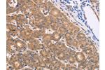 The image on the left is immunohistochemistry of paraffin-embedded Human thyroid cancer tissue using CSB-PA969912(BTG3 Antibody) at dilution 1/15, on the right is treated with fusion protein. (Original magnification: 