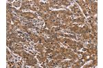 The image on the left is immunohistochemistry of paraffin-embedded Human liver cancer tissue using CSB-PA969975(FAAH2 Antibody) at dilution 1/30, on the right is treated with fusion protein. (Original magnification: 