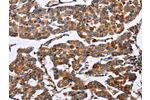 The image on the left is immunohistochemistry of paraffin-embedded Human breast cancer tissue using CSB-PA970254(ENPP5 Antibody) at dilution 1/60, on the right is treated with fusion protein. (Original magnification: 