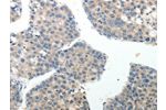 The image on the left is immunohistochemistry of paraffin-embedded Human liver cancer tissue using CSB-PA970308(ABI3BP Antibody) at dilution 1/20, on the right is treated with synthetic peptide. (Original magnification: 