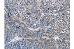 The image on the left is immunohistochemistry of paraffin-embedded Human liver cancer tissue using CSB-PA970433(AKR1D1 Antibody) at dilution 1/25, on the right is treated with fusion protein. (Original magnification: 