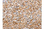 The image on the left is immunohistochemistry of paraffin-embedded Human prostate cancer tissue using CSB-PA970469(ABCC8 Antibody) at dilution 1/40, on the right is treated with synthetic peptide. (Original magnification: 