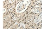 The image on the left is immunohistochemistry of paraffin-embedded Human lung cancer tissue using CSB-PA970487(FZD10 Antibody) at dilution 1/50, on the right is treated with synthetic peptide. (Original magnification: 
