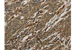 The image on the left is immunohistochemistry of paraffin-embedded Human gastric cancer tissue using CSB-PA970771(AIF1 Antibody) at dilution 1/50, on the right is treated with fusion protein. (Original magnification: 