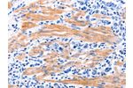 The image on the left is immunohistochemistry of paraffin-embedded Human stomach cancer tissue using CSB-PA971102(GDF9 Antibody) at dilution 1/7, on the right is treated with fusion protein. (Original magnification: 