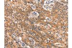 The image on the left is immunohistochemistry of paraffin-embedded Human gastic cancer tissue using CSB-PA971984(BCL3 Antibody) at dilution 1/15, on the right is treated with synthetic peptide. (Original magnification: 