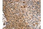 The image on the left is immunohistochemistry of paraffin-embedded Human esophagus cancer tissue using CSB-PA972227(CNGA1 Antibody) at dilution 1/25, on the right is treated with synthetic peptide. (Original magnification: 