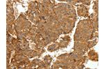 The image on the left is immunohistochemistry of paraffin-embedded Human lung cancer tissue using CSB-PA972442(COL4A1 Antibody) at dilution 1/30, on the right is treated with synthetic peptide. (Original magnification: 