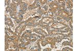 The image on the left is immunohistochemistry of paraffin-embedded Human thyroid cancer tissue using CSB-PA972891(CWC27 Antibody) at dilution 1/40, on the right is treated with synthetic peptide. (Original magnification: 