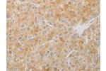 The image on the left is immunohistochemistry of paraffin-embedded Human liver cancer tissue using CSB-PA973928(AES Antibody) at dilution 1/20, on the right is treated with fusion protein. (Original magnification: 