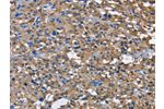 The image on the left is immunohistochemistry of paraffin-embedded Human thyroid cancer tissue using CSB-PA974344(CD160 Antibody) at dilution 1/60, on the right is treated with fusion protein. (Original magnification: 