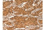 The image on the left is immunohistochemistry of paraffin-embedded Human gastic cancer tissue using CSB-PA974724(CHUK Antibody) at dilution 1/15, on the right is treated with synthetic peptide. (Original magnification: 