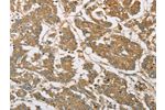 The image on the left is immunohistochemistry of paraffin-embedded Human colon cancer tissue using CSB-PA975347(EIF3F Antibody) at dilution 1/30, on the right is treated with fusion protein. (Original magnification: 