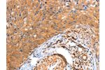 The image on the left is immunohistochemistry of paraffin-embedded Human cervical cancer tissue using CSB-PA975419(ACOX3 Antibody) at dilution 1/35, on the right is treated with fusion protein. (Original magnification: 