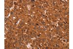 The image on the left is immunohistochemistry of paraffin-embedded Human liver cancer tissue using CSB-PA975999(CCND3 Antibody) at dilution 1/40, on the right is treated with synthetic peptide. (Original magnification: 
