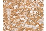 The image on the left is immunohistochemistry of paraffin-embedded Human thyroid cancer tissue using CSB-PA976017(CPB1 Antibody) at dilution 1/60, on the right is treated with fusion protein. (Original magnification: 