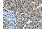 The image on the left is immunohistochemistry of paraffin-embedded Human liver cancer tissue using CSB-PA976066(CRLF2 Antibody) at dilution 1/60, on the right is treated with synthetic peptide. (Original magnification: 