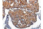 The image on the left is immunohistochemistry of paraffin-embedded Human breast cancer tissue using CSB-PA976397(FGF2 Antibody) at dilution 1/100, on the right is treated with synthetic peptide. (Original magnification: 