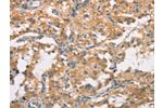The image on the left is immunohistochemistry of paraffin-embedded Human thyroid cancer tissue using CSB-PA977299(CRHR2 Antibody) at dilution 1/15, on the right is treated with synthetic peptide. (Original magnification: 