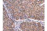 The image on the left is immunohistochemistry of paraffin-embedded Human ovarian cancer tissue using CSB-PA977329(EFNA5 Antibody) at dilution 1/40, on the right is treated with synthetic peptide. (Original magnification: 