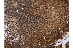 The image on the left is immunohistochemistry of paraffin-embedded Human cervical cancer tissue using CSB-PA977533(FHL3 Antibody) at dilution 1/40, on the right is treated with fusion protein. (Original magnification: 