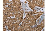 The image on the left is immunohistochemistry of paraffin-embedded Human prostate cancer tissue using CSB-PA977537(GBP5 Antibody) at dilution 1/40, on the right is treated with fusion protein. (Original magnification: 