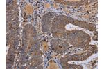 The image on the left is immunohistochemistry of paraffin-embedded Human colon cancer tissue using CSB-PA978301(FADS1 Antibody) at dilution 1/50, on the right is treated with fusion protein. (Original magnification: 