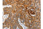 The image on the left is immunohistochemistry of paraffin-embedded Human esophagus cancer tissue using CSB-PA978373(AQP5 Antibody) at dilution 1/40, on the right is treated with synthetic peptide. (Original magnification: 