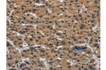 The image on the left is immunohistochemistry of paraffin-embedded Human liver cancer tissue using CSB-PA979246(CLDN2 Antibody) at dilution 1/50, on the right is treated with synthetic peptide. (Original magnification: 
