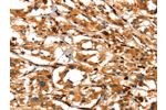 The image on the left is immunohistochemistry of paraffin-embedded Human thyroid cancer tissue using CSB-PA979441(ACTA2 Antibody) at dilution 1/40, on the right is treated with synthetic peptide. (Original magnification: 