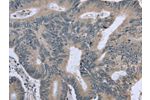 The image on the left is immunohistochemistry of paraffin-embedded Human colon cancer tissue using CSB-PA979712(BMX Antibody) at dilution 1/30, on the right is treated with fusion protein. (Original magnification: 