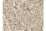 The image on the left is immunohistochemistry of paraffin-embedded Human lung cancer tissue using CSB-PA980450(ANXA2 Antibody) at dilution 1/40, on the right is treated with fusion protein. (Original magnification: 