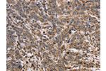 The image on the left is immunohistochemistry of paraffin-embedded Human liver cancer tissue using CSB-PA980670(EPOR Antibody) at dilution 1/40, on the right is treated with synthetic peptide. (Original magnification: 